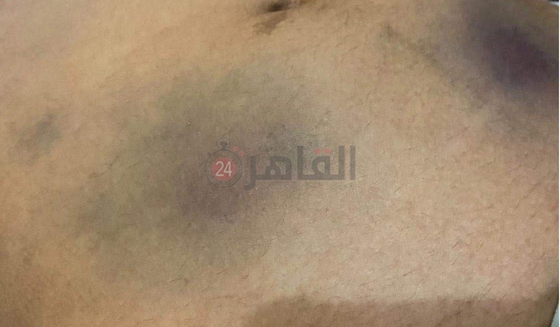 جانب من آثار الضرب الذي تعرضت له الطالبة