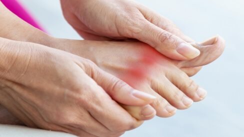 كيف يمكن لمرضى النقرس أكل لحمة العيد 