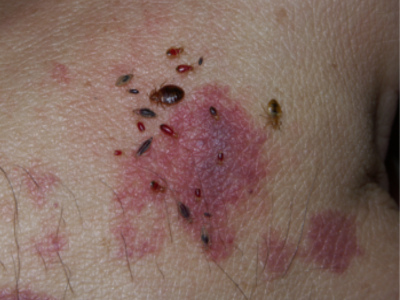 تفسير البق على الجسم في المنام للمتزوجة