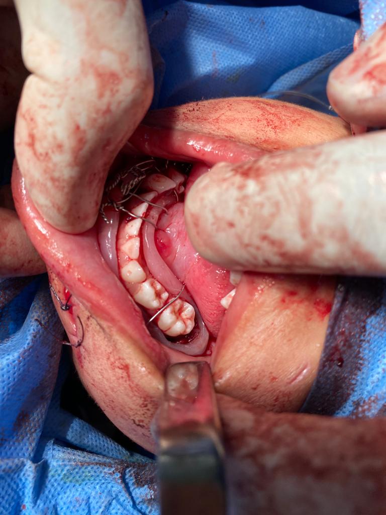 العملية الجراحية