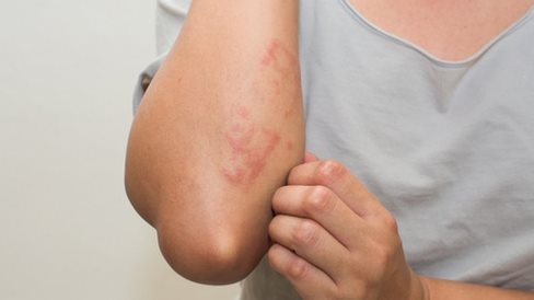 خطورة إزالة الشعر بالليزر للنساء