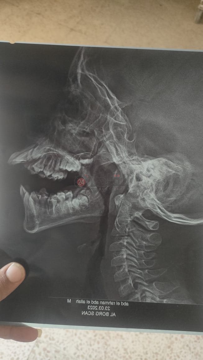 أشعة توضح خطورة حالة العم جلال 03