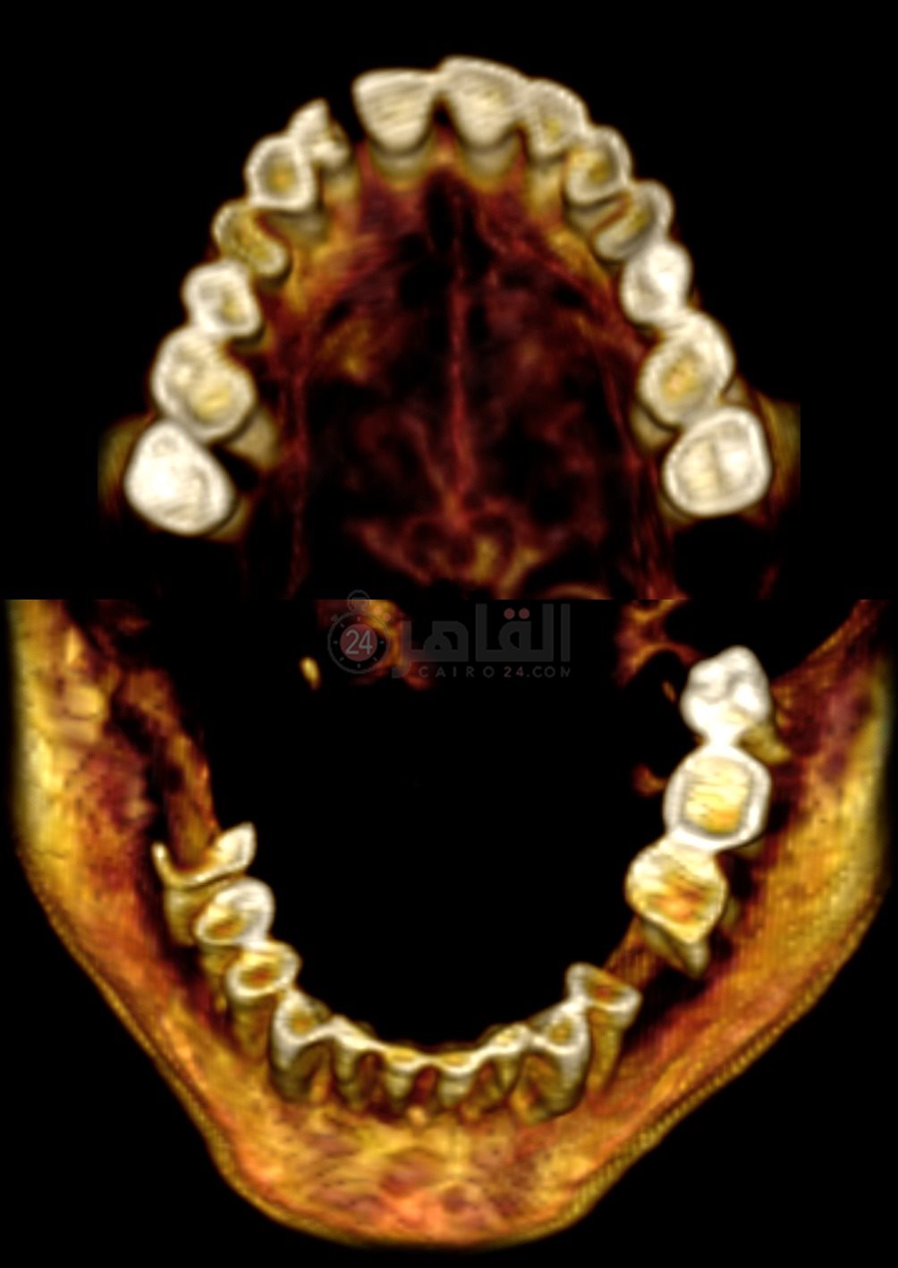 فم واسنان مومياء المرأة الصارخة (2)