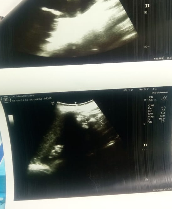 اشاعة تثبت تعرض عبد الحليم لتهتك الكلي 