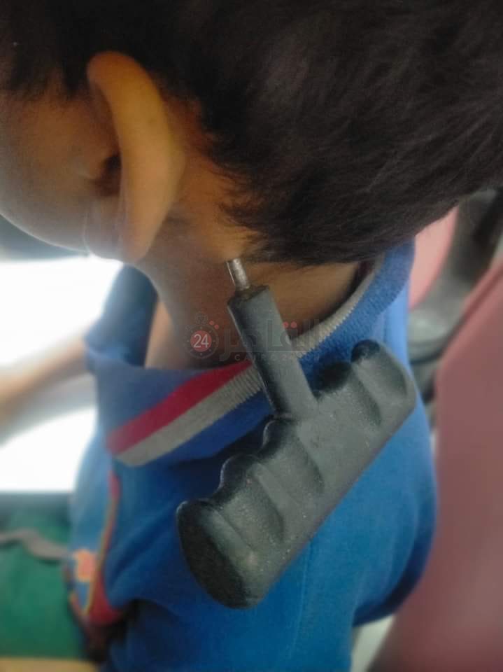 طاقم جراحة ينجح في استخراج مفك حديدي من رقبة طالب بالفيوم