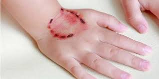 تفسير عضة الكلب في المنام