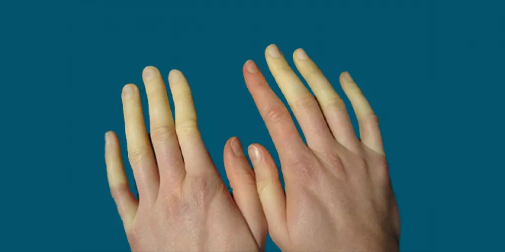 علاج ازرقاق إصبع اليد