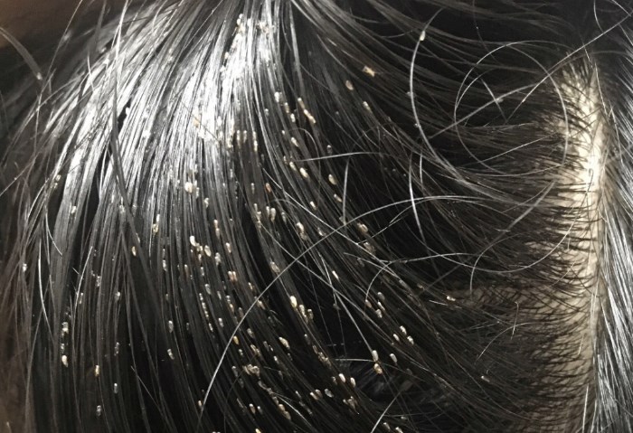 تفسير حلم وجود قمل في الشعر