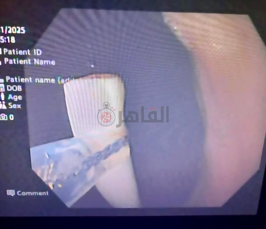 صورة بيانية خلال إجراء العملية 