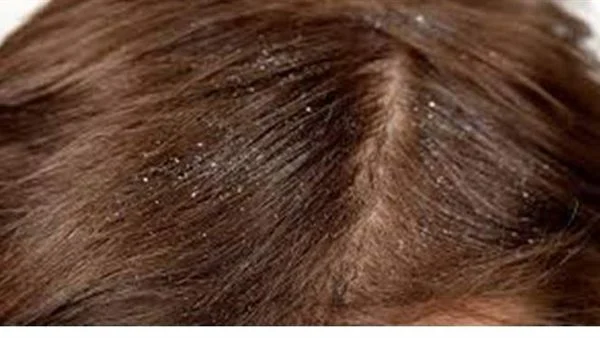 تفسير حلم نزع القمل من الشعر للعزباء.. دليل على المعاناة