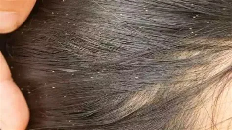 تفسير حلم نزع القمل من الشعر للعزباء