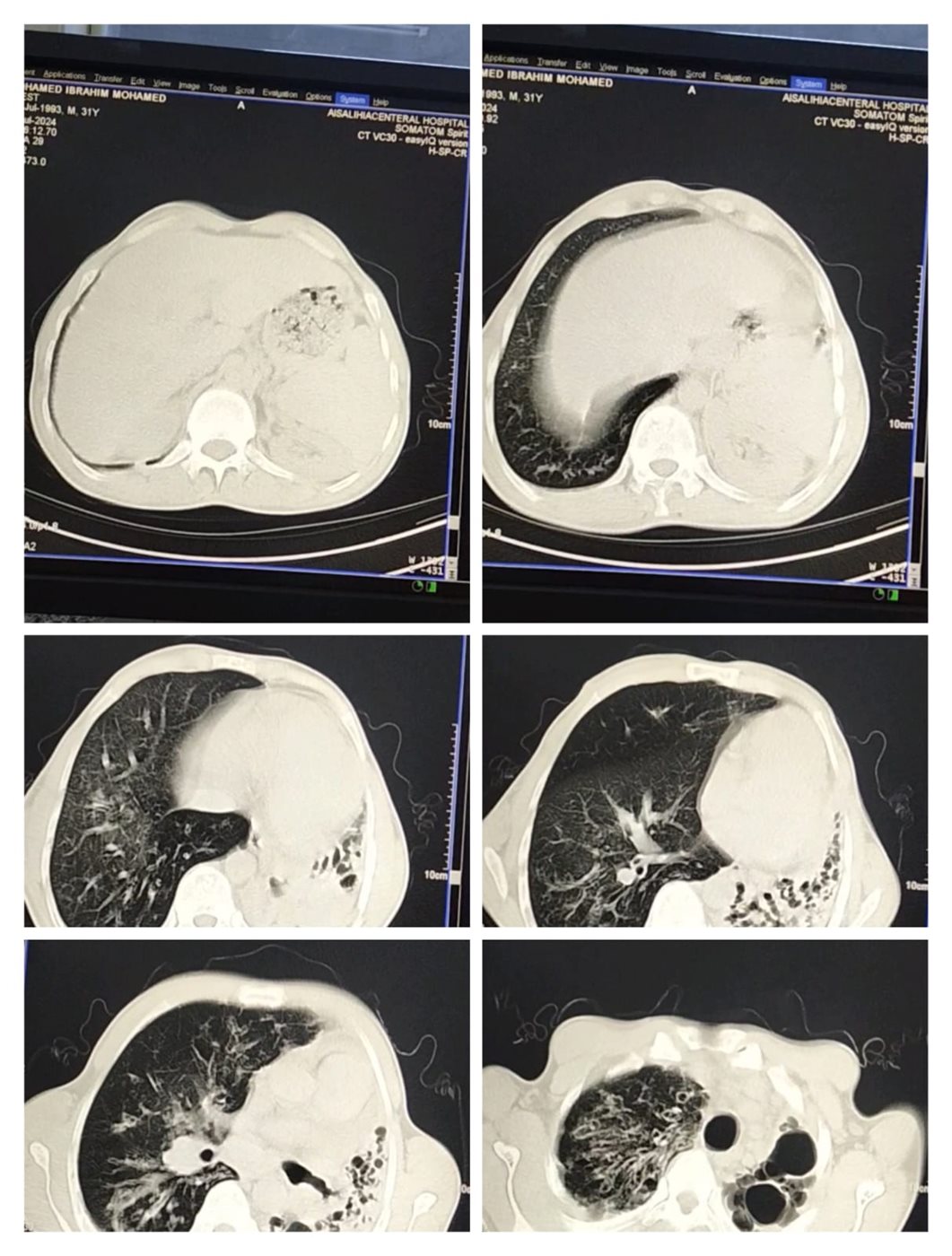 تقرير طبي لحالة محمد إبراهيم مصاب التليف الرئوي&nbsp;