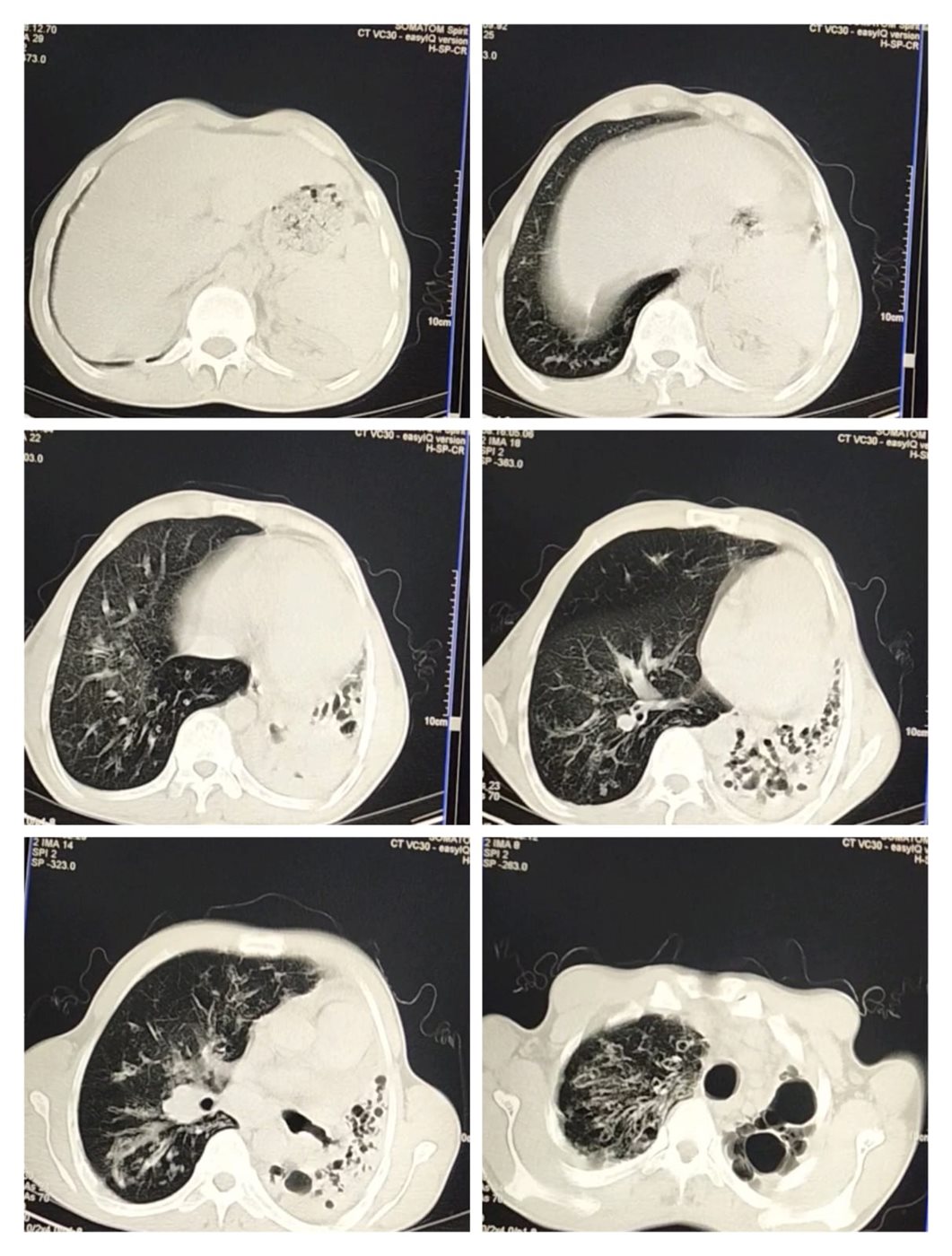 تقرير طبي لحالة محمد إبراهيم مصاب التليف الرئوي&nbsp;