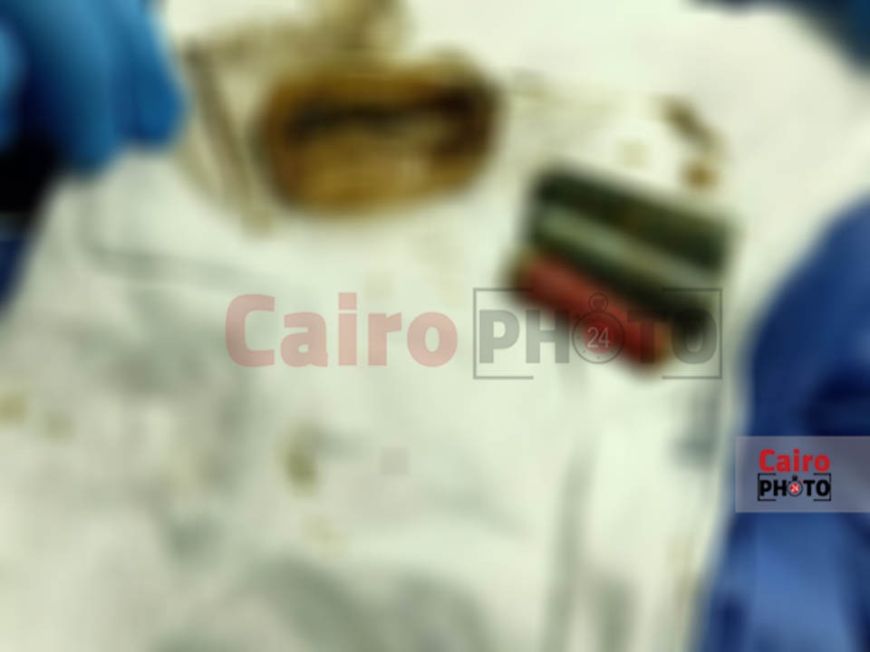 استخراج ثلاث حجارة من بطن مريض بالمنوفية بعد بلعهم من عام ونصف 