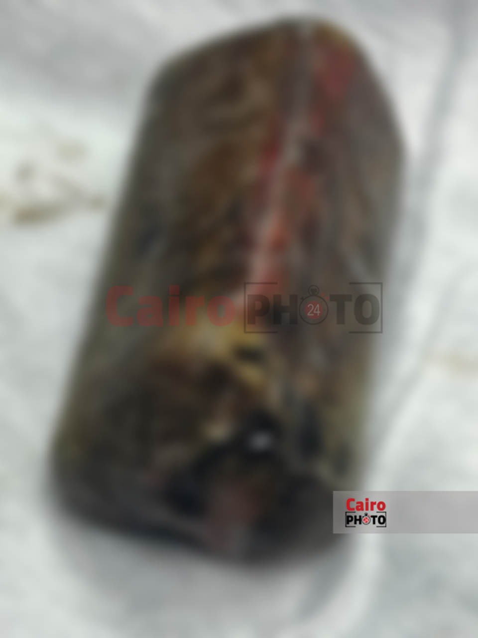 استخراج ثلاث حجارة من بطن مريض بالمنوفية بعد بلعهم من عام ونصف 