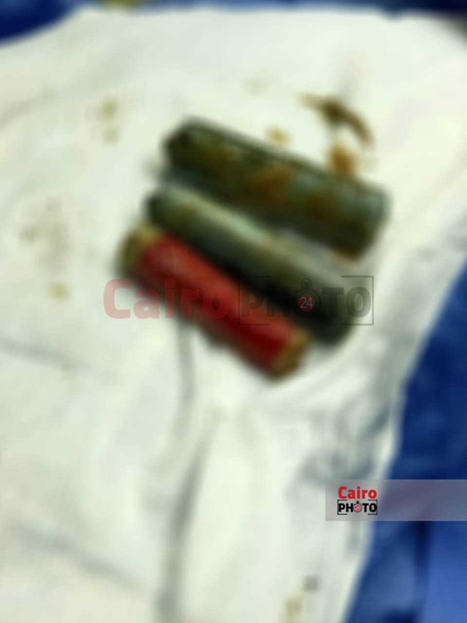 استخراج ثلاث حجارة من بطن مريض بالمنوفية بعد بلعهم من عام ونصف 