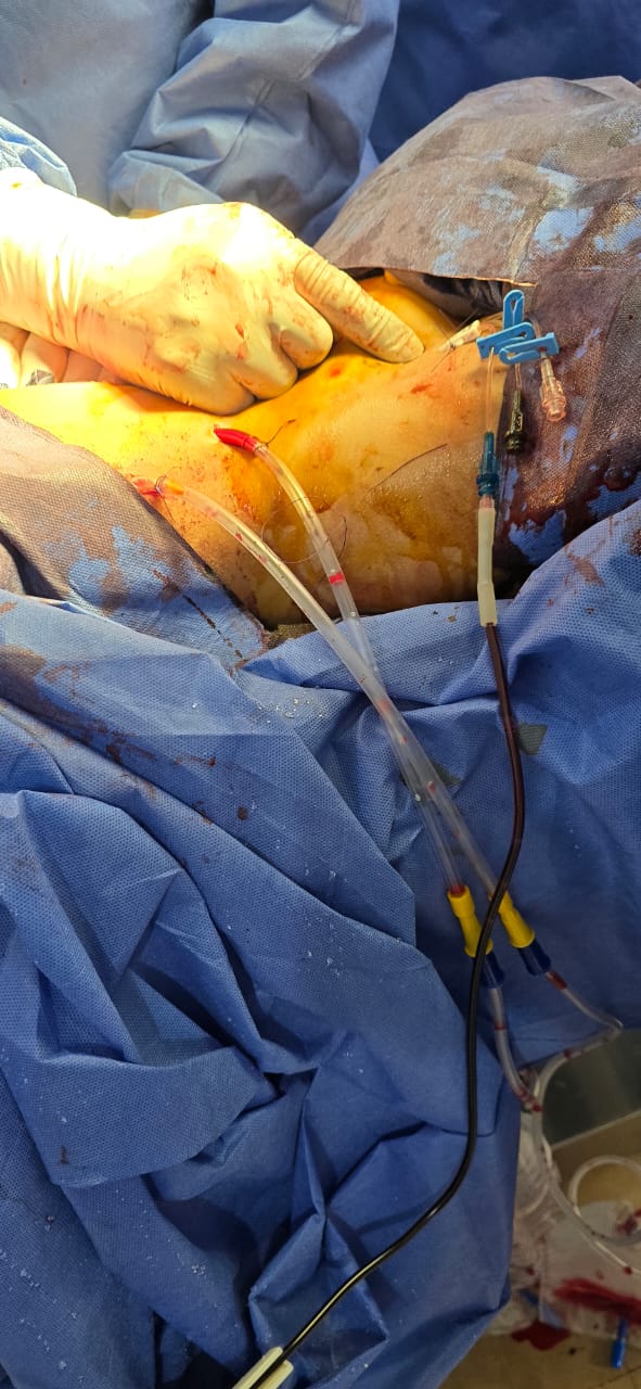 جانب من الجراحة 