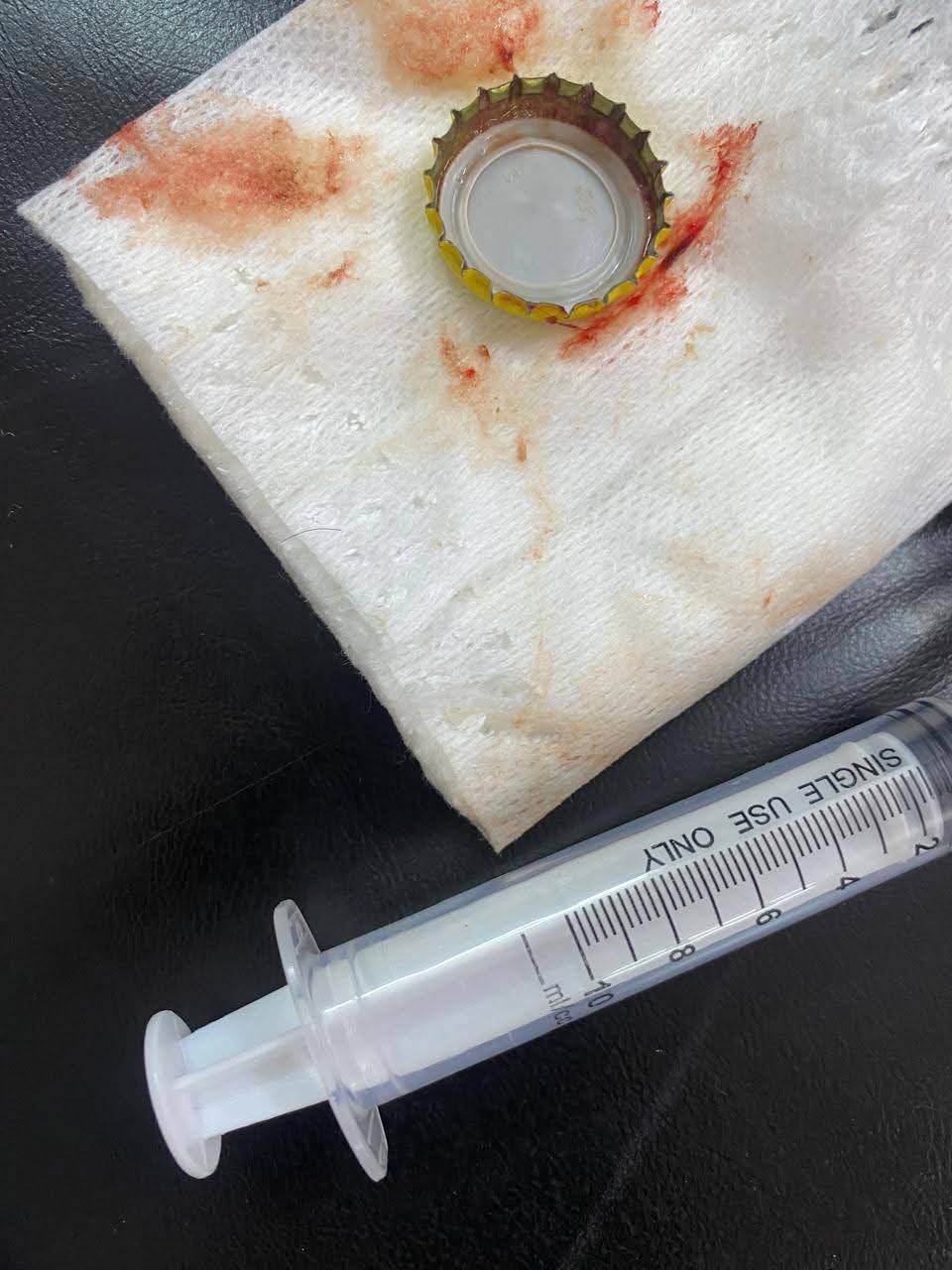 استخراج غطاء معدني من معدة مريض بالأقصر