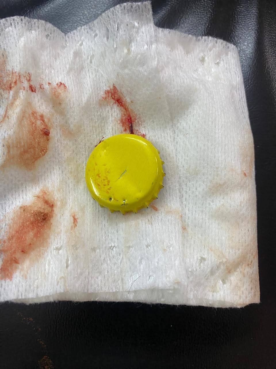 استخراج غطاء معدني من معدة مريض بالأقصر