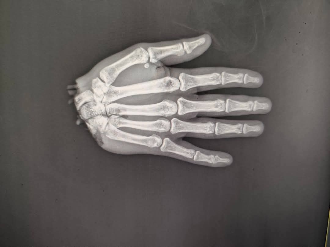 أشعة تظهر يد المريض بعد قطعها في حادث وقبل إجراء العملية 