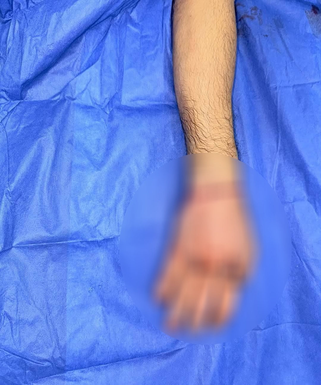 يد المريض بعد نجاح العملية داخل قسم جراحة التجميل بمستشفى سيد جلال الجامعي