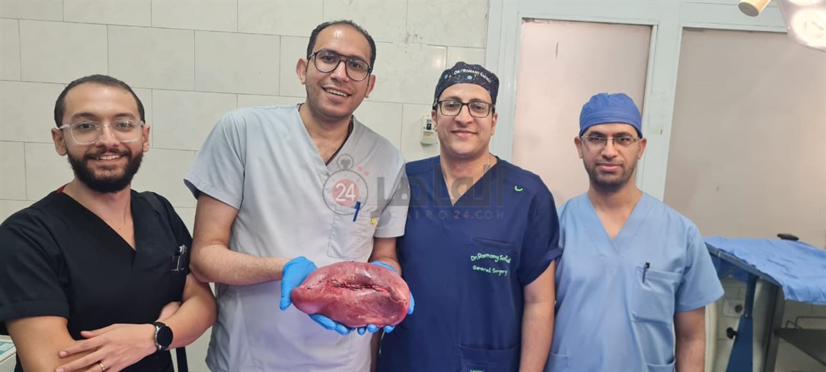 فريق طبي بمستشفى أسيوط العام ينجح في استئصال طحال متضخم يزن 2 كجم من مريضة