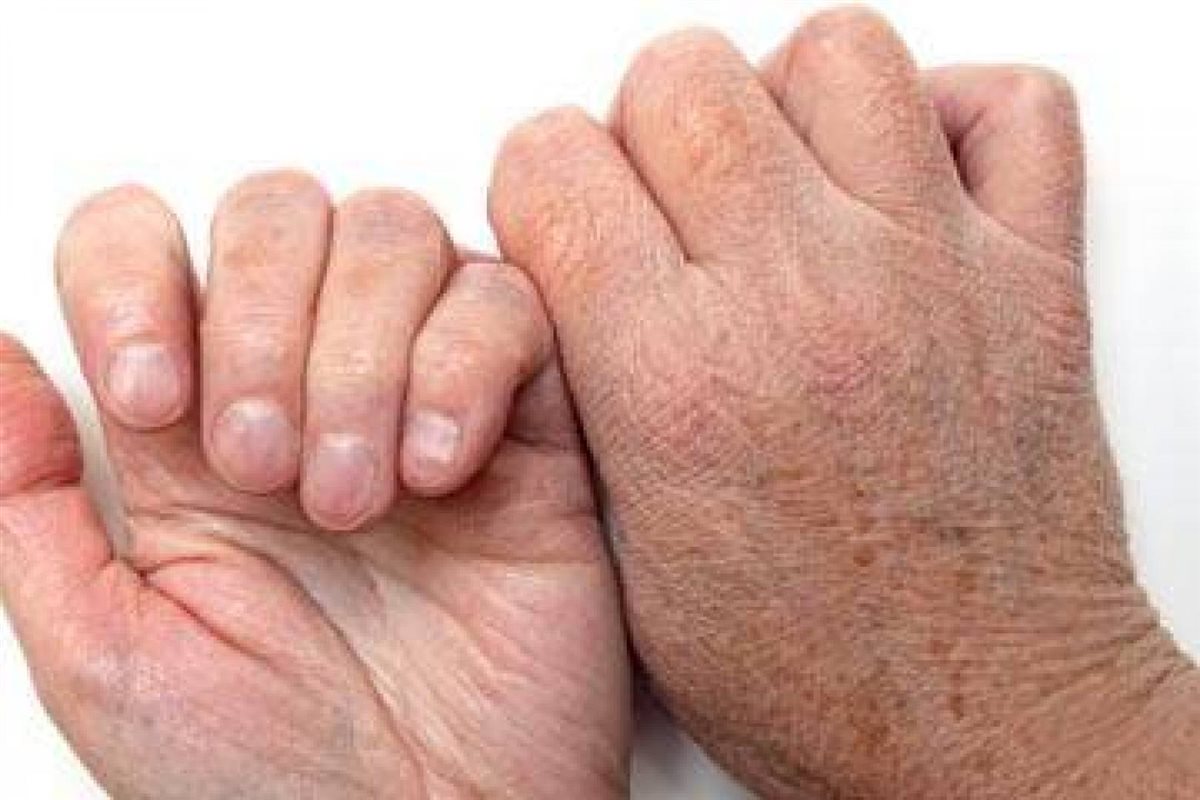 أعراض الجفاف عند الكبار والأطفال وطرق الوقاية