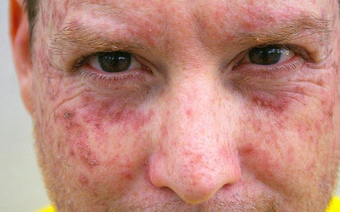 أضرار التعرض للشمس لفترات طويلة