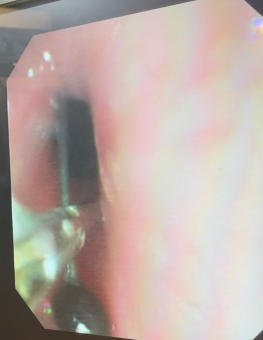 فريق طبي ينجح في استخراج دبوس من معدة صغير 4 سنوات بمستشفى سوهاج الجامعي