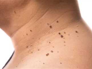 أفضل طرق علاج مقاومة الانسولين بفعالية وأمان