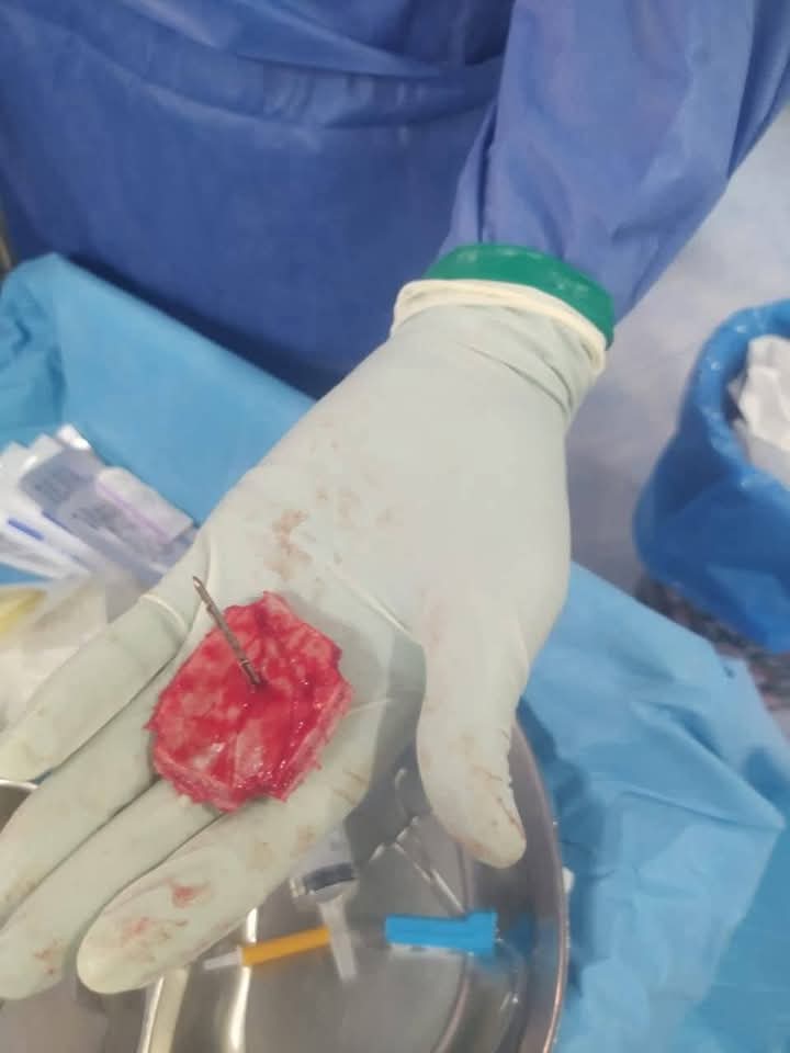 استخراج مسمار اخترق رأس صغير 