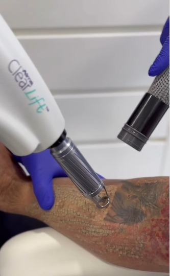 أحمد سعد يبدأ مرحلة ازالة الوشم  ويُعلق: من أحسن القرارات اللي أخدتها