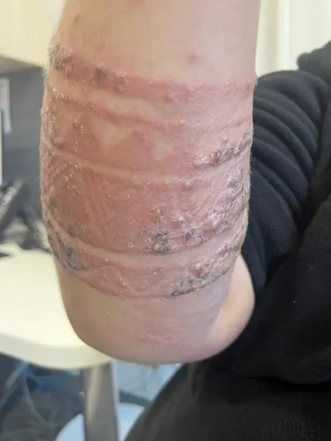 أم تكشف عن رد فعل تحسسي خطير لطفلها بسبب الحناء