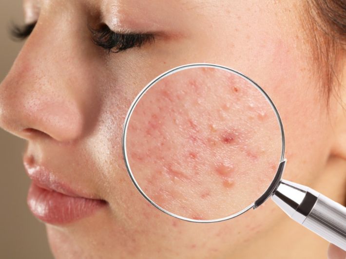 كيفية التخلص من حبوب تحت الجلد في الوجه نهائيًا بوصفات طبيعية