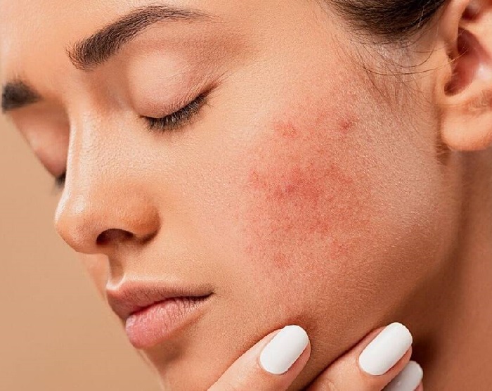 كيفية التخلص من حبوب تحت الجلد في الوجه نهائيًا بوصفات طبيعية