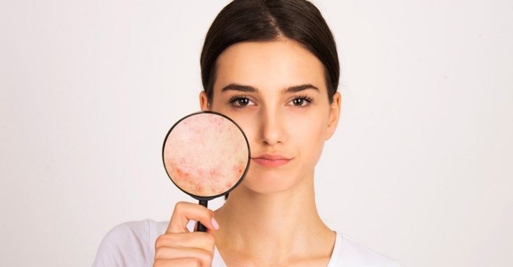 طريقة عمل ماسك طبيعي لتفتيح البشرة الدهنية وإزالة الحبوب