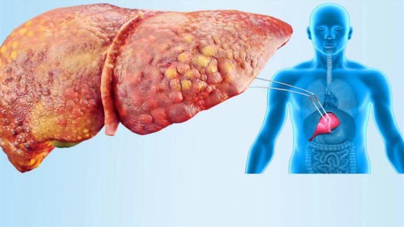 مشروبات طبيعية فعالة لتنظيف الكبد من السموم