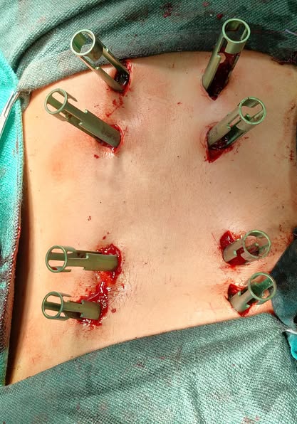 سقط من ارتفاع 7 أمتار.. طب أسيوط الأزهر تجري عملية لتثبيت العمود الفقري باستخدام تقنية التدخل المحدود<br> 