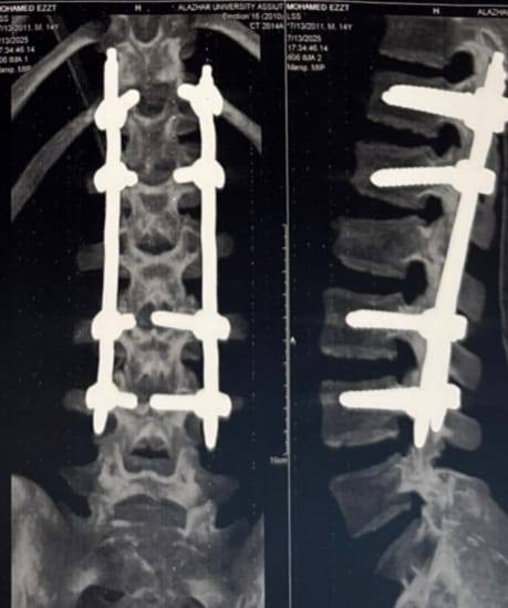 سقط من ارتفاع 7 أمتار.. طب أسيوط الأزهر تجري عملية لتثبيت العمود الفقري باستخدام تقنية التدخل المحدود<br> 