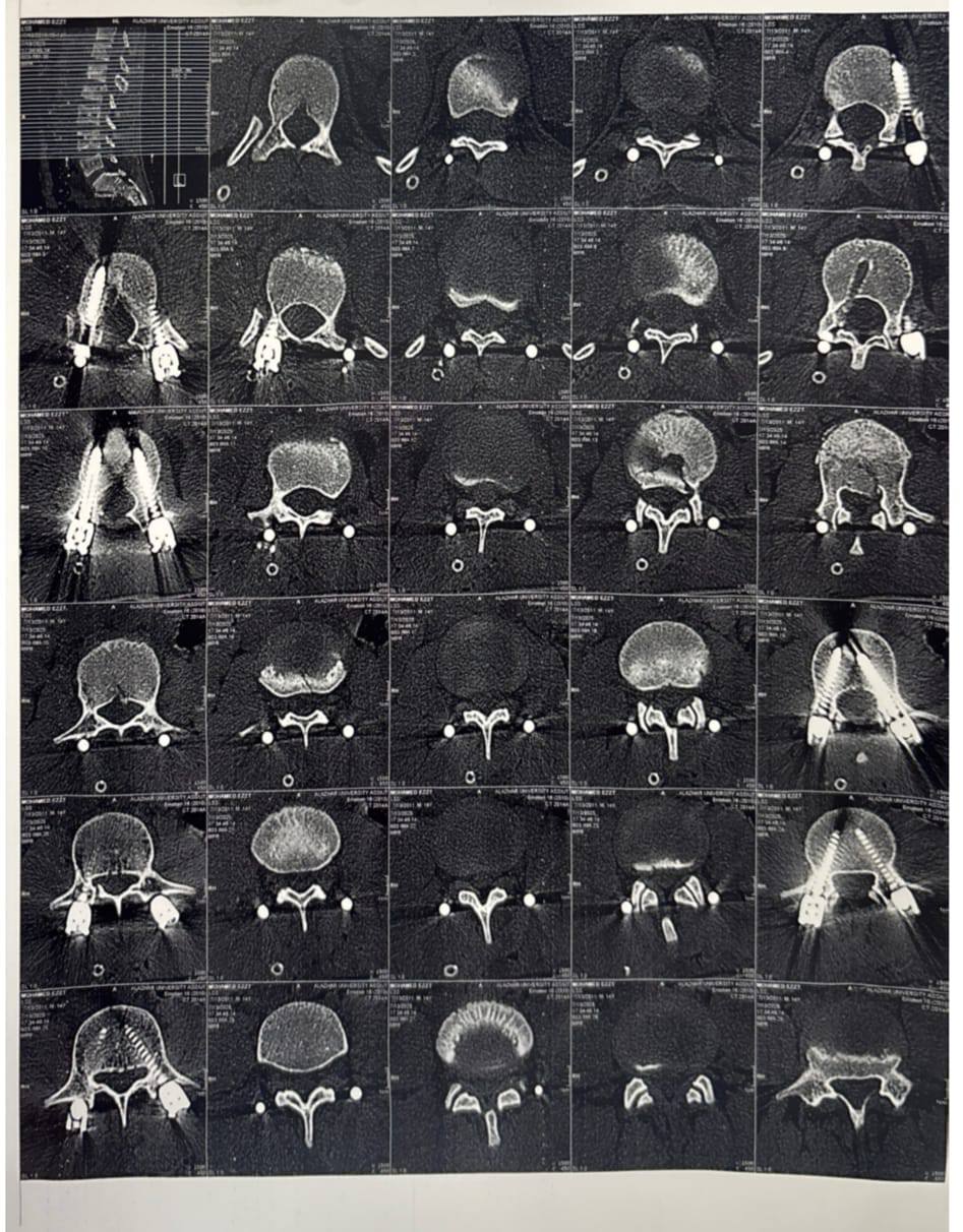 سقط من ارتفاع 7 أمتار.. طب أسيوط الأزهر تجري عملية لتثبيت العمود الفقري باستخدام تقنية التدخل المحدود<br> 