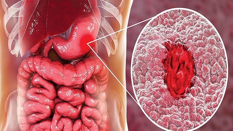 أطعمة ممنوعة لمرضى جرثومة المعدة