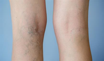 الوقاية من الدوالي