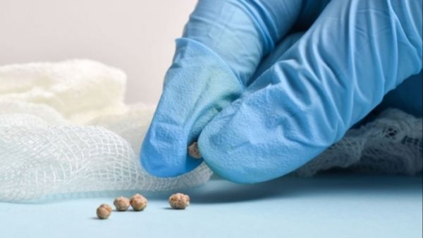 ما هي حصوات المرارة؟