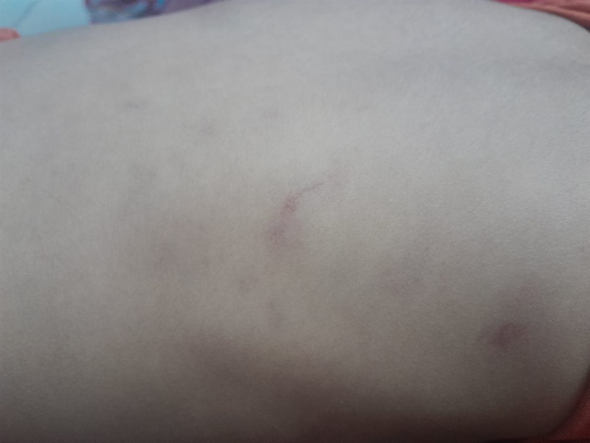 آثار الضرب على الصغير