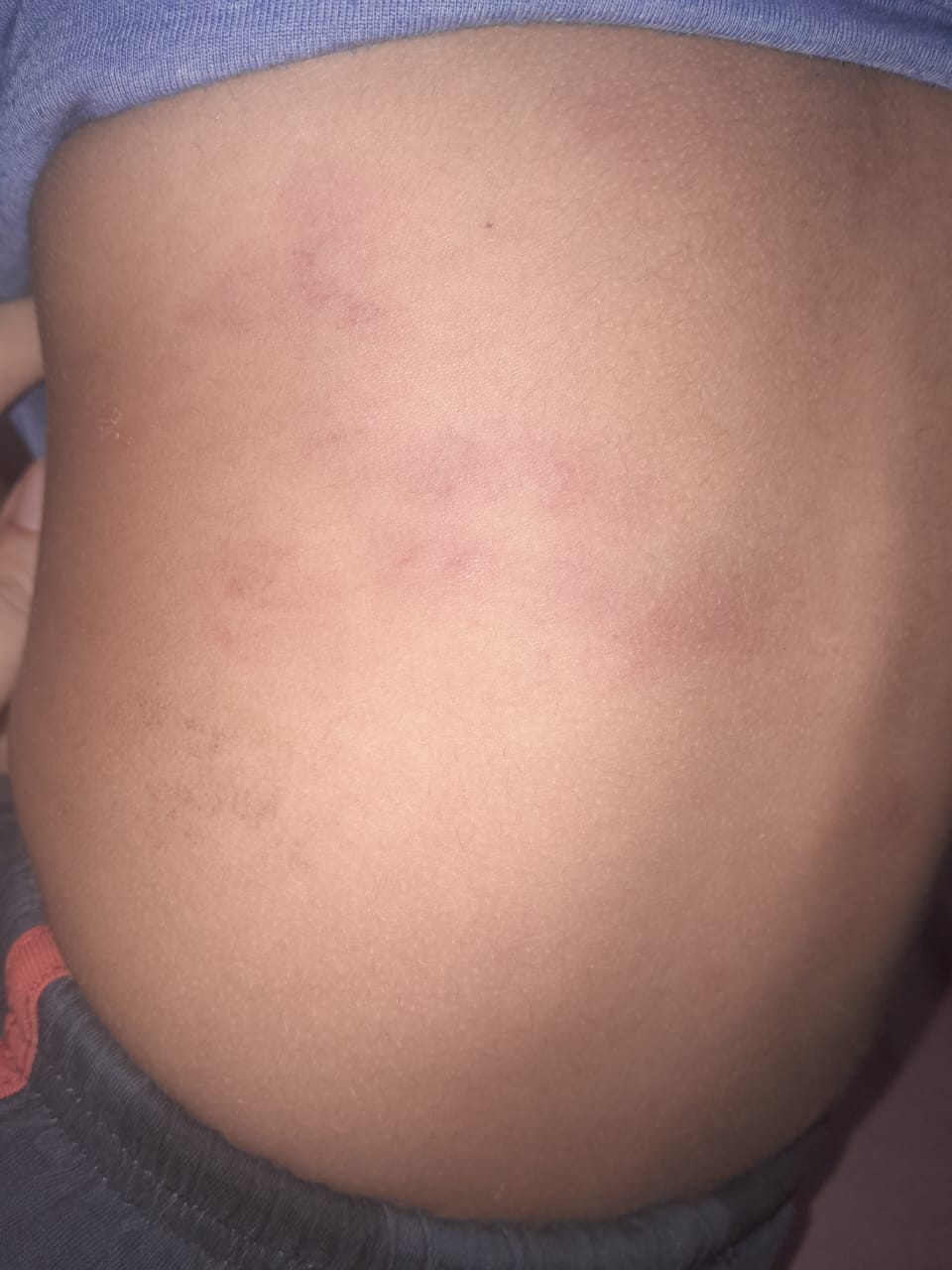 آثار الضرب على الصغير