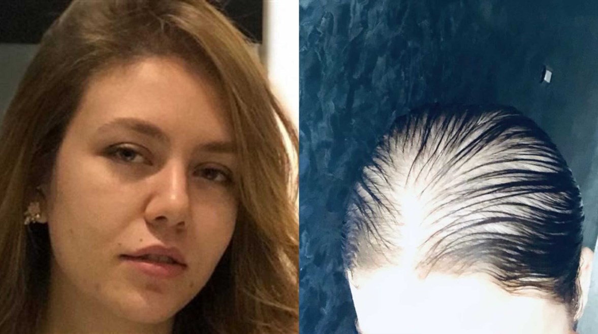 إصابة رحمة حسن بالصلع