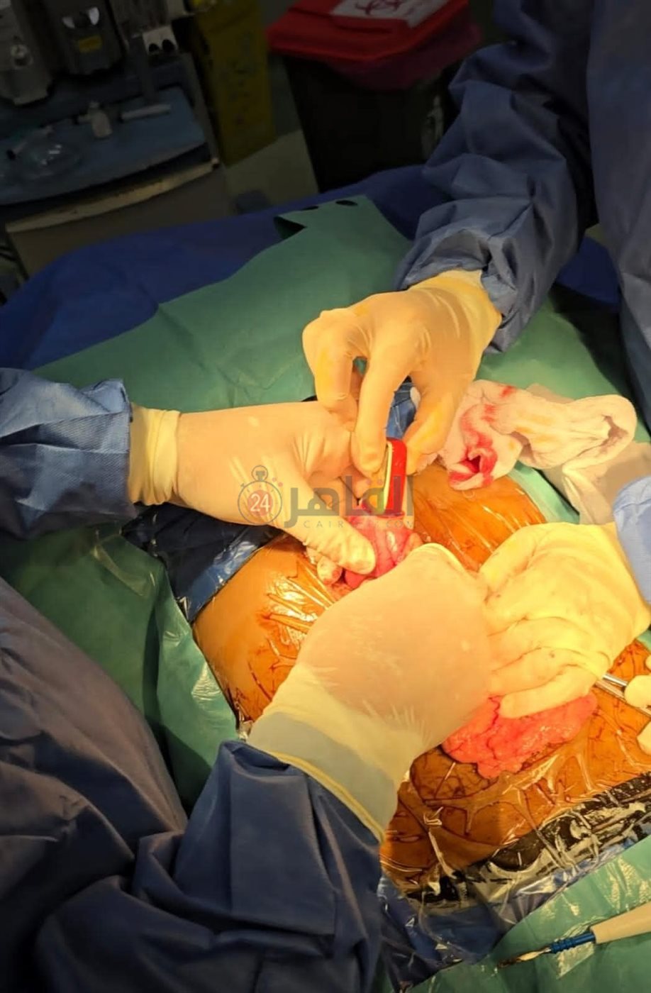 فريق طبي يستخرج تليفون محمول من معدة مريض 