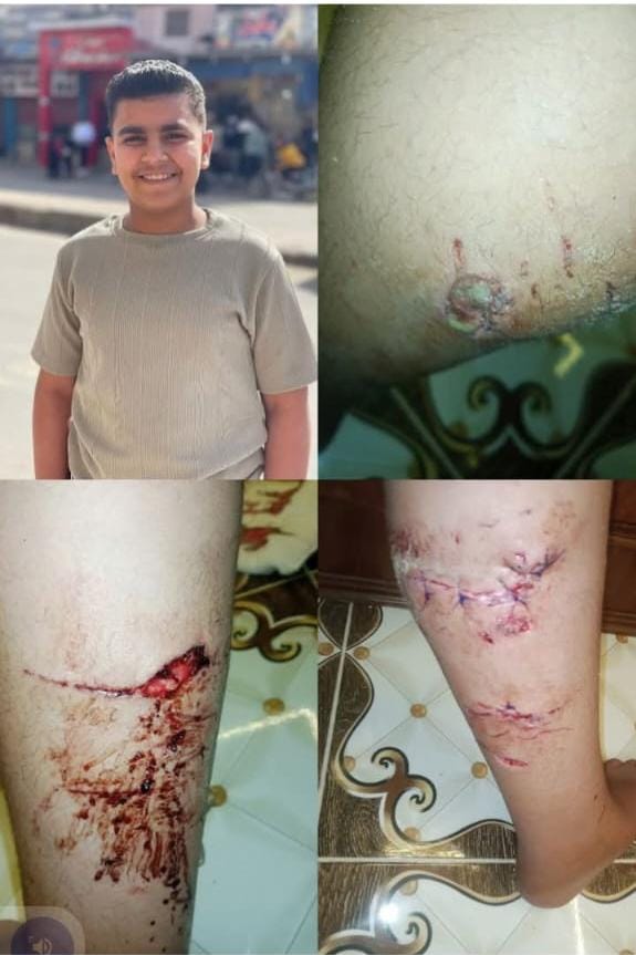 الصغير المصاب 