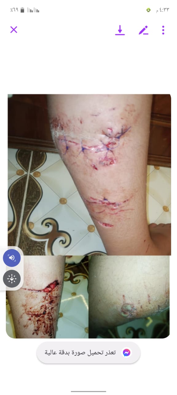 الصغير المصاب 