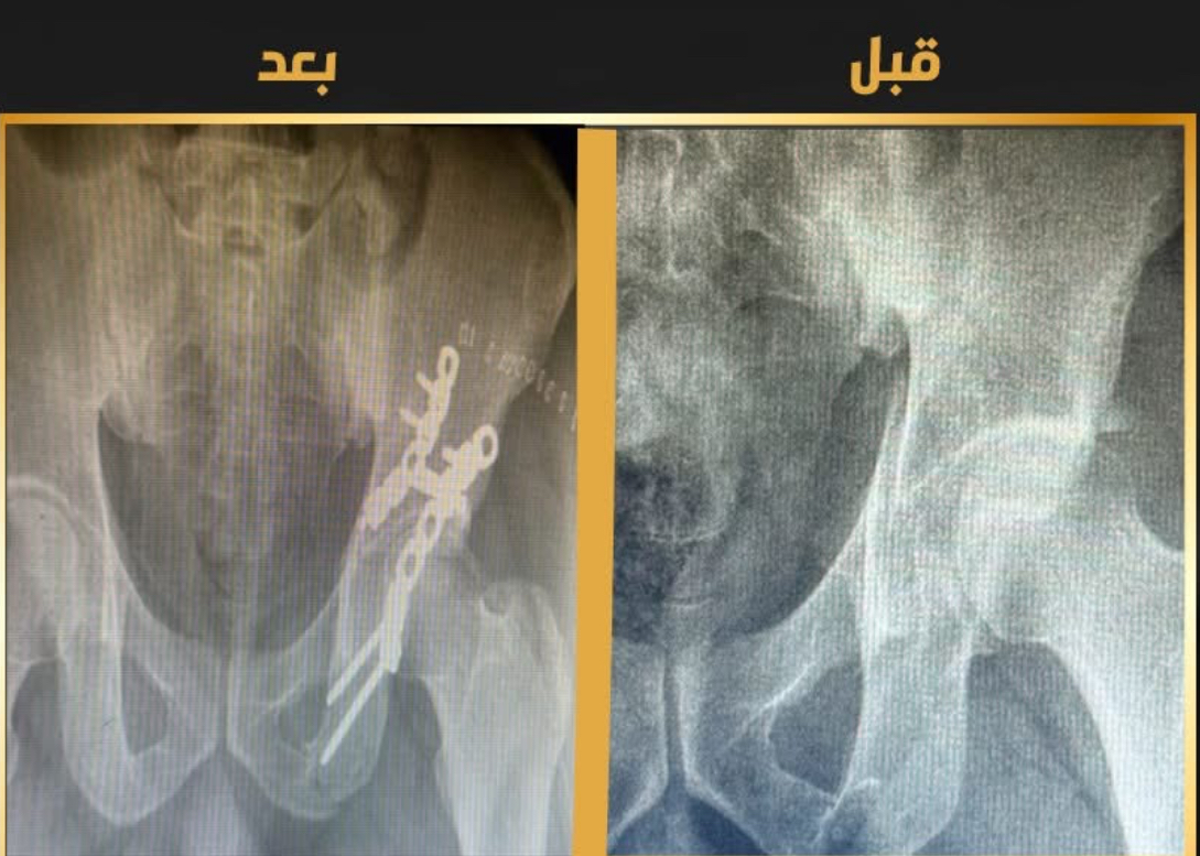 علاج كسور في الحوض بمجمع الأقصر الطبي الدولي